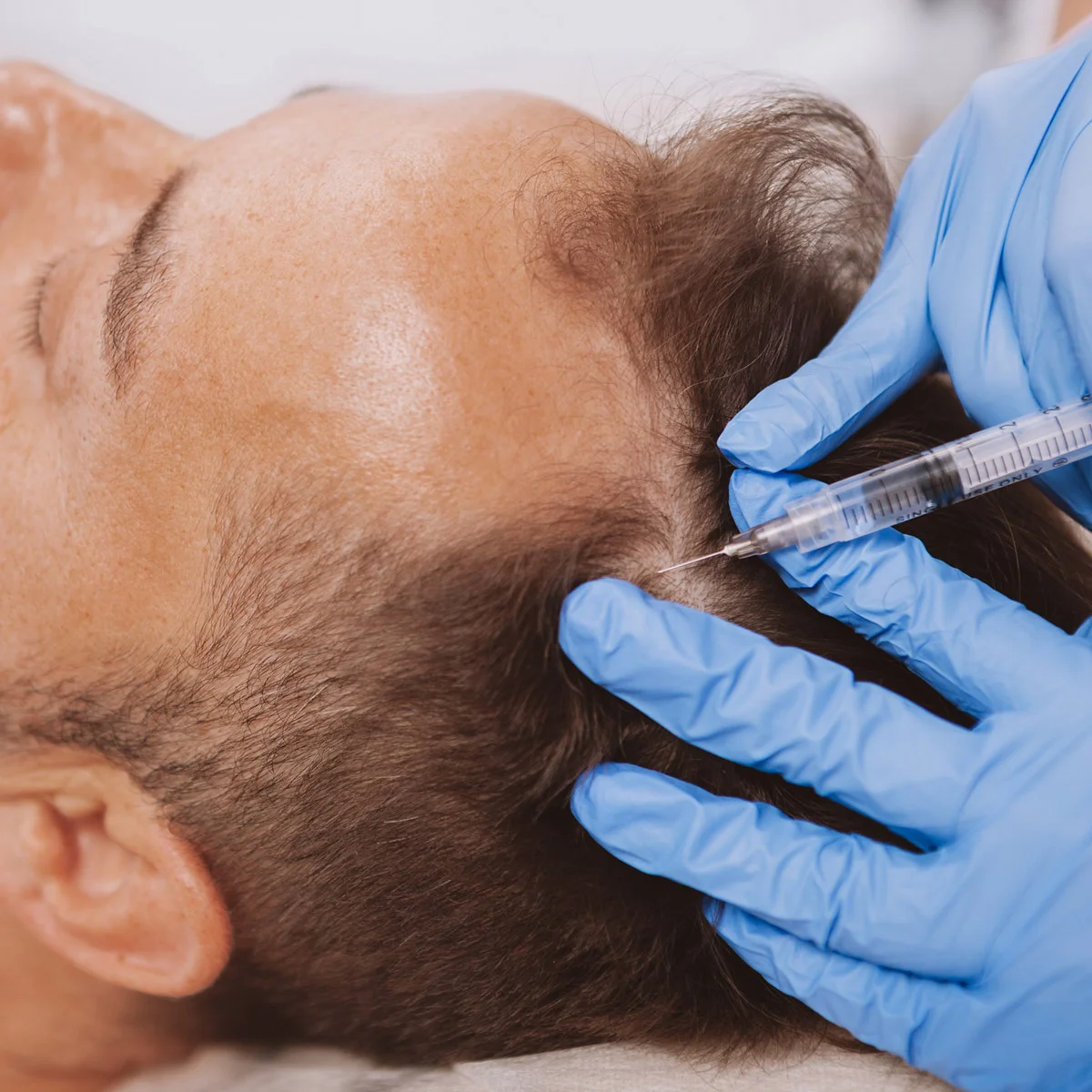 Middle-aged man getting PRP Injections in his scalp