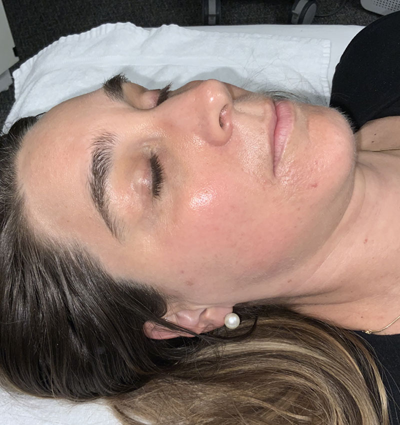 Microneedling After