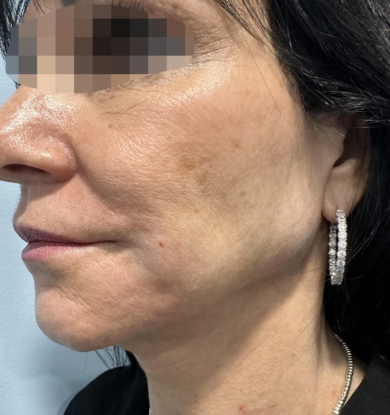 Dermal Fillers