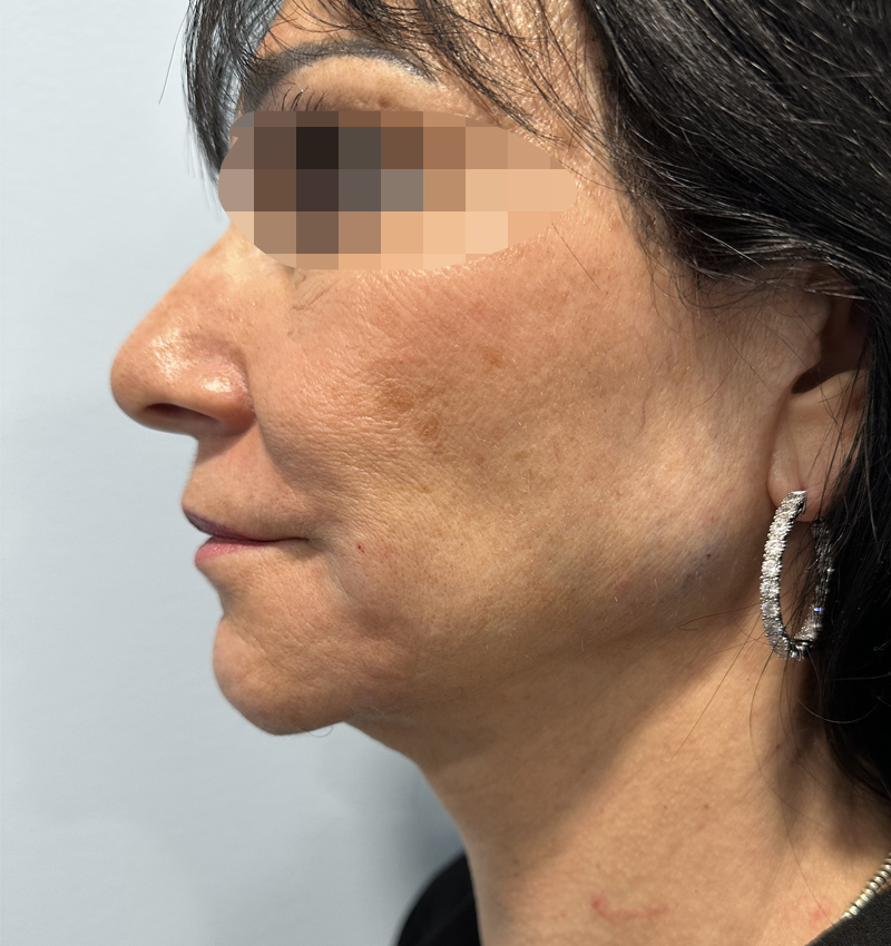 Dermal Fillers