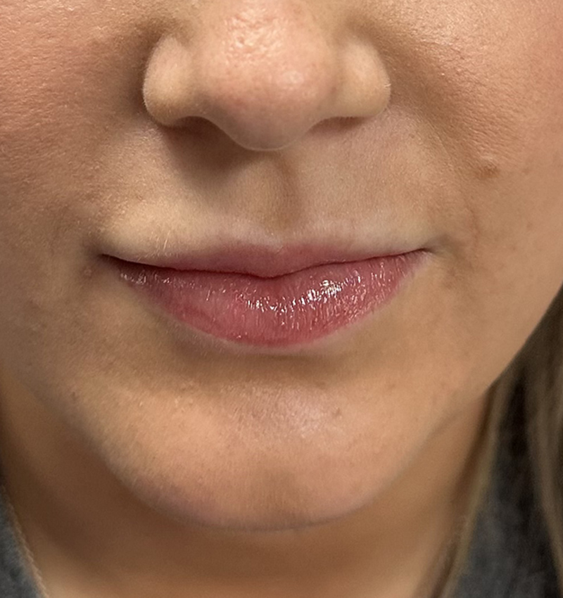 Lip Fillers